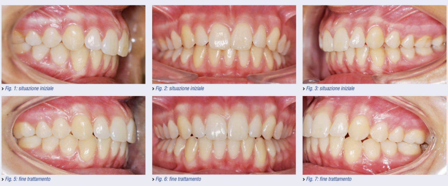 Trattamento ortodontico di asimmetria dento-alveolare digitale 3D