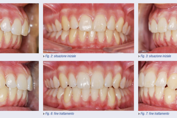 Trattamento ortodontico di asimmetria dento-alveolare digitale 3D